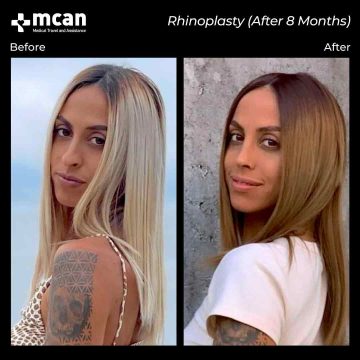 Rhinoplasty surgery before and after 3