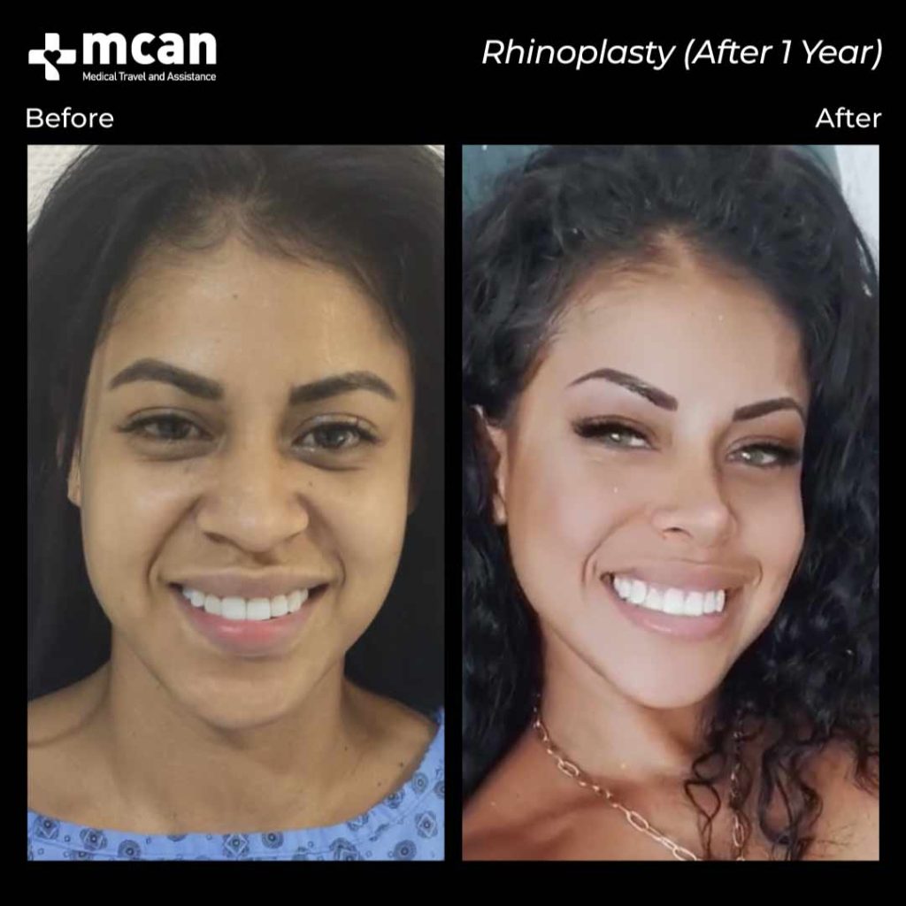 rhinoplasty1 5 min