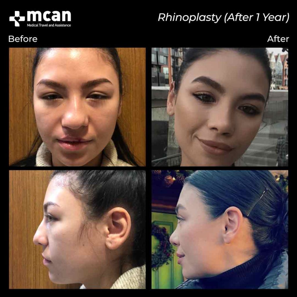 rhinoplasty6 min