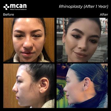 Rhinoplasty surgery before and after 1