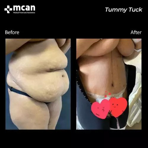 Tummy Tuck Turkey Before & After