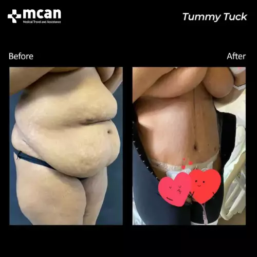 tummy tuck before after turkey