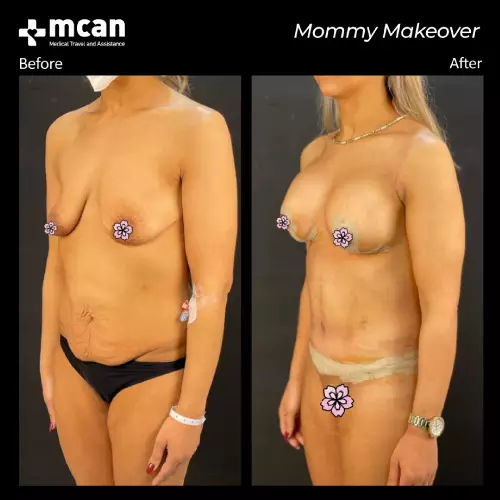 tummy tuck turkey before after