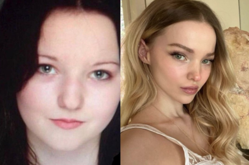 Dove Cameron Plastic Surgery is evident in this Before and After Picture