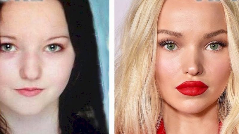 Dove Cameron Before and After Picture showing a clear lip enhancement Dove Cameron Before and After Picture showing a clear lip enhancement
