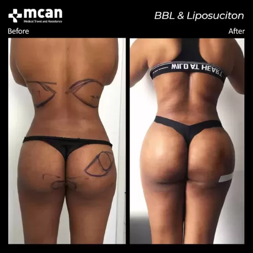 bbl liposuction turkey