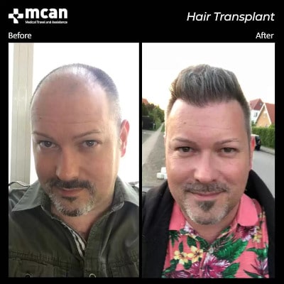 До и после пересадки волос в Турции