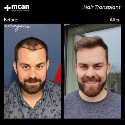 Пример до и после пересадки волос в Турции
