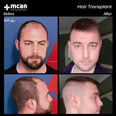Пример до и после пересадки волос в Турции