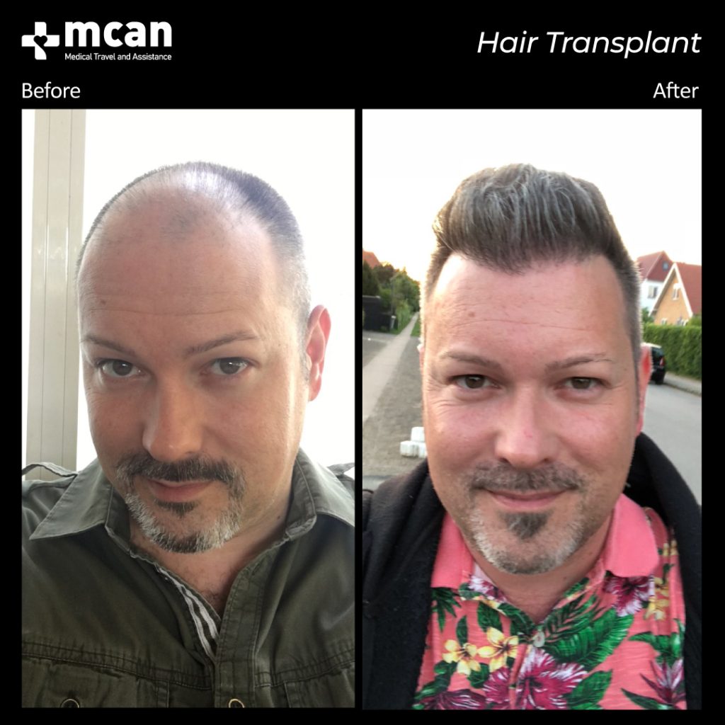 hair transplant turkey before after 1 1