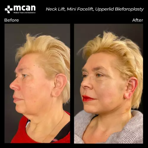 lady facelift turkey before after
