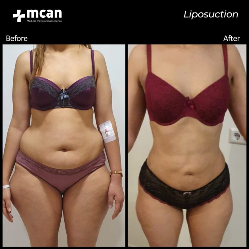 Foto de antes y después de una liposuccion con la paciente en claro sobrepeso a la izquierda y figura delgada a la derecha