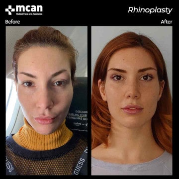 Rhinoplasty surgery before and after 2