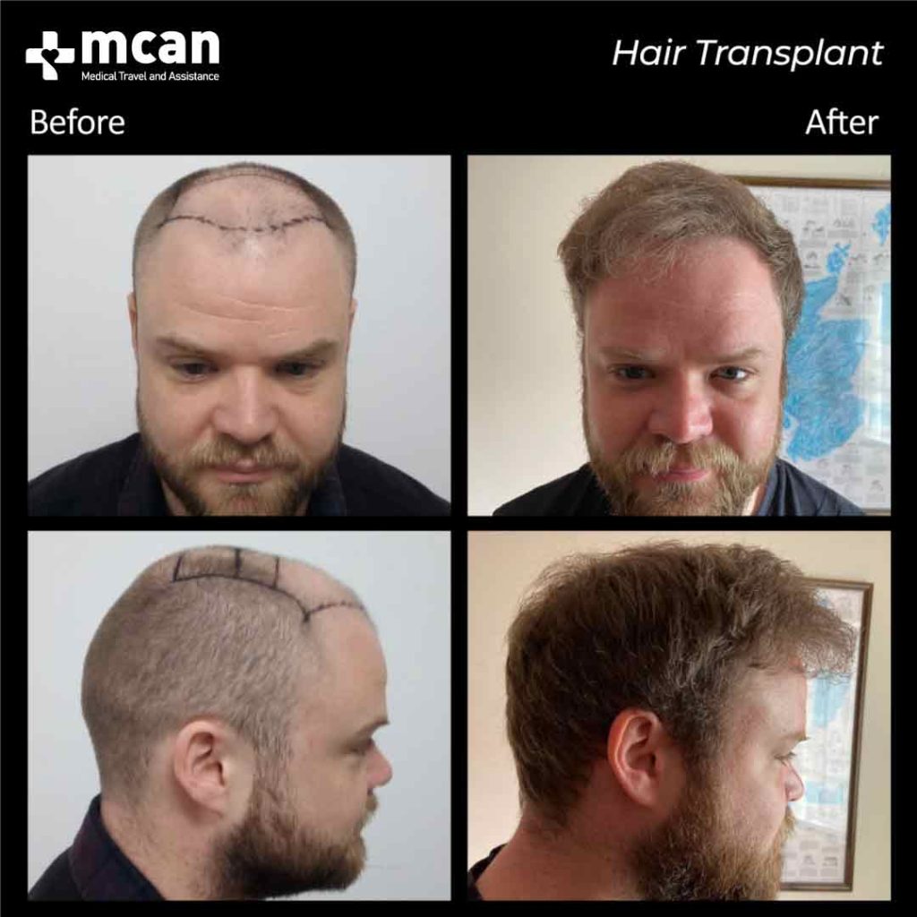 transplant in turkey before after 04 1