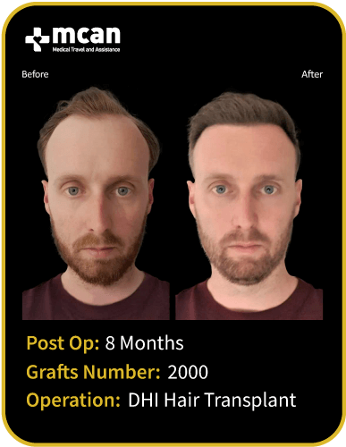 before after