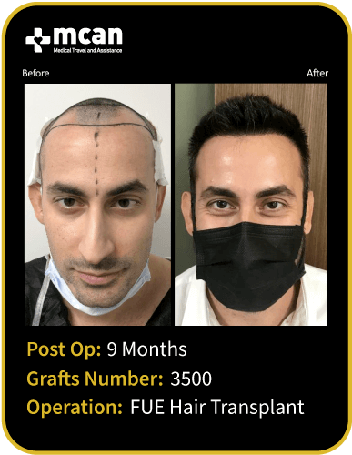 before after