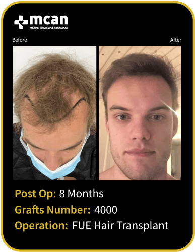 before after