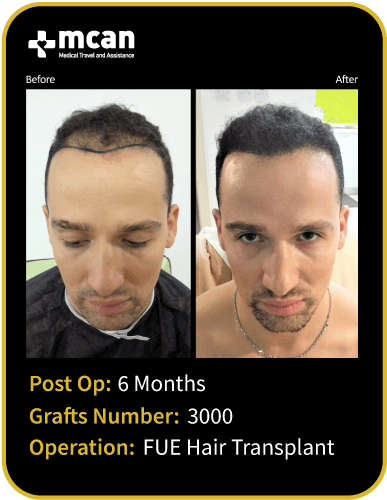 before after