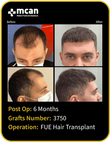 before after