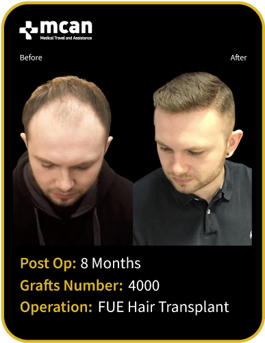before after