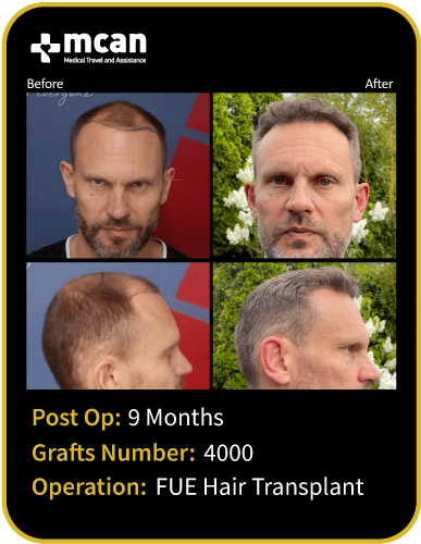 before after