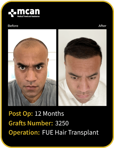 before after