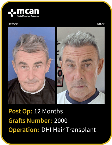 before after