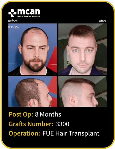 before after