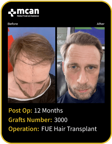 before after