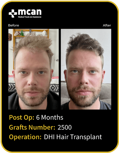 before after