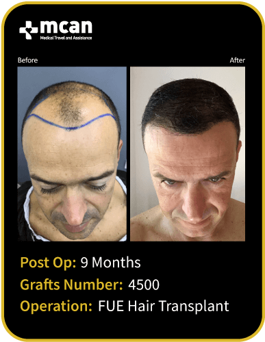 before after