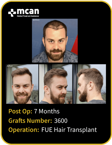 before after