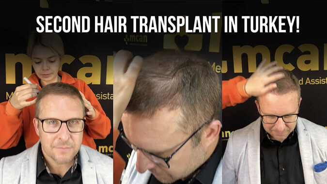 fue hair transplant turkey animation