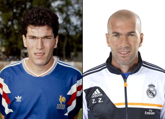 Zidane Hair Transplant