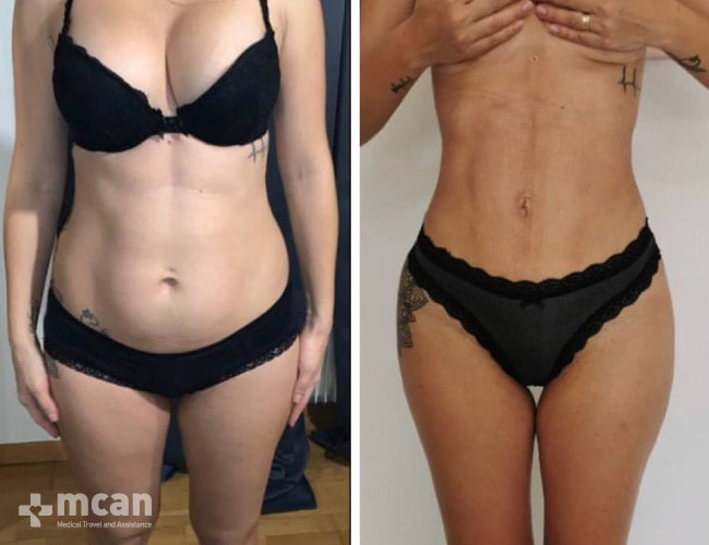 Liposuction vorher nachher