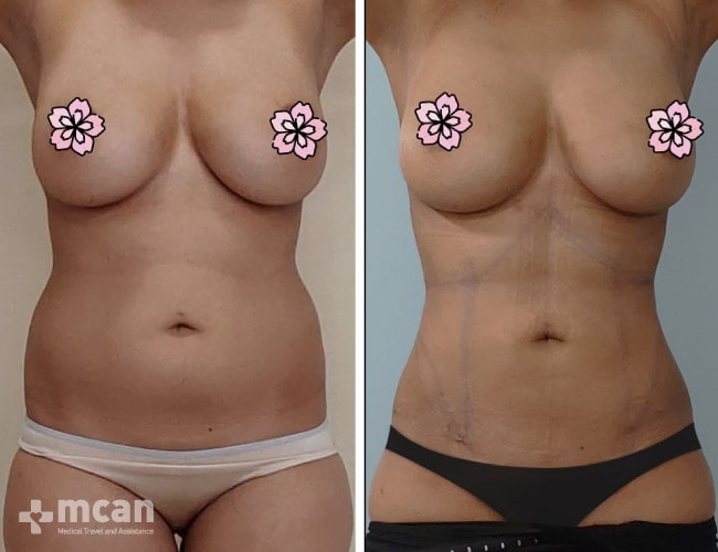Liposuction before after 13