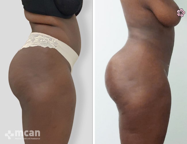 Liposuction - Before After 14