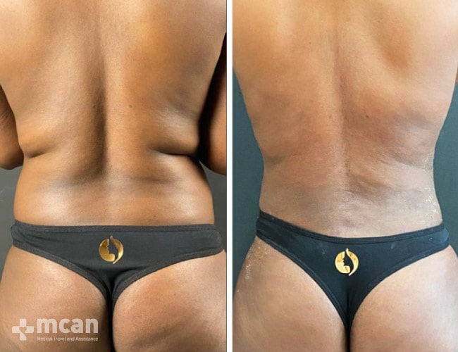 Liposuction - Before After 15