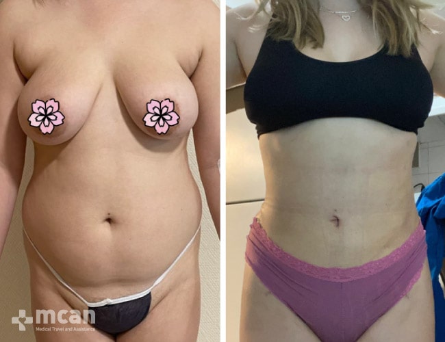 Liposuction - Before After 16