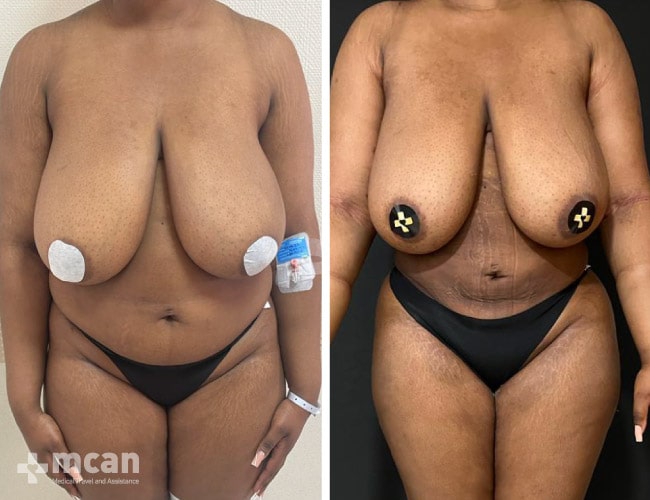 Liposuction before after 18