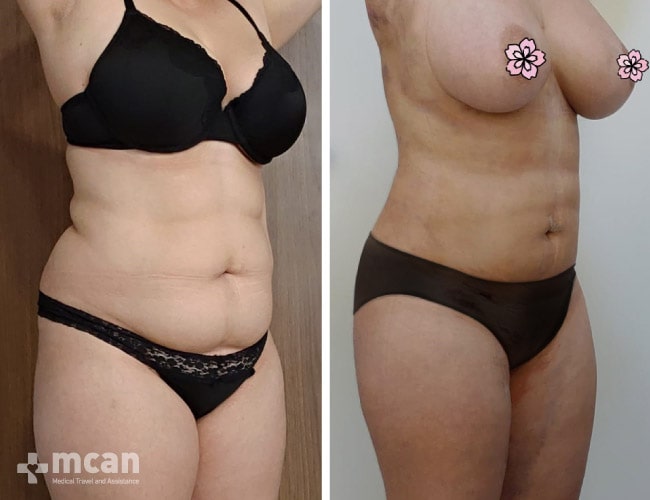Liposuction - Before After 19