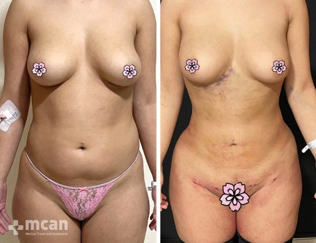 Frau vor und nach der Operation