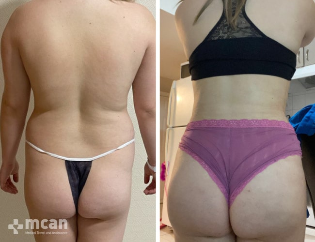Liposuction - Before After 21