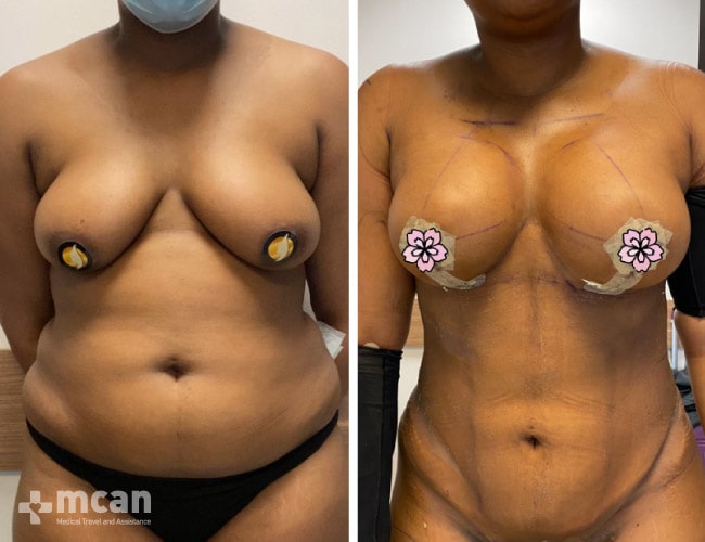 Liposuction before after 4