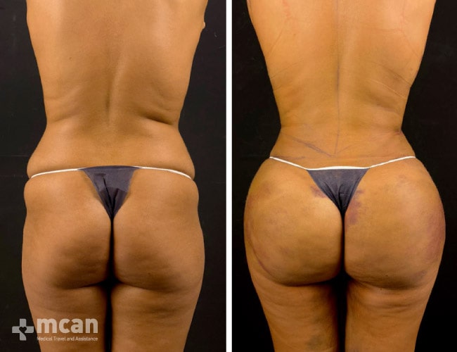 Liposuction before after 5