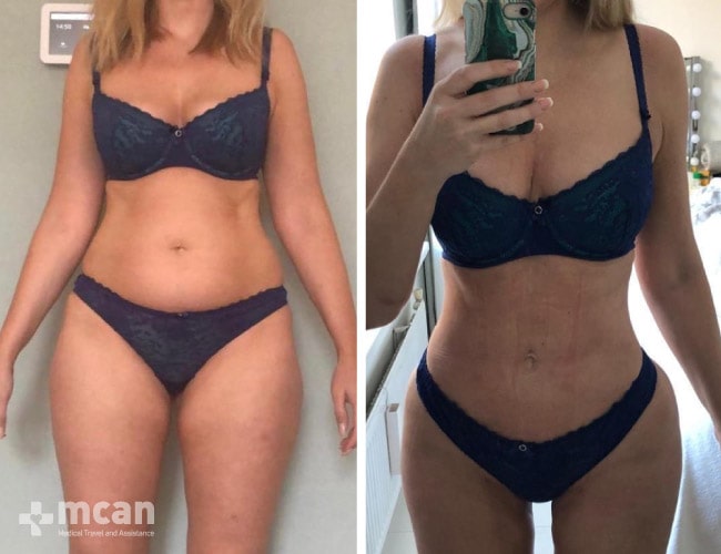 Liposuction before after 6