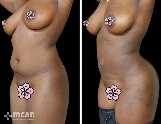 Liposuction before after 9