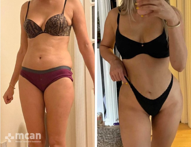 The perfect body reshaping results