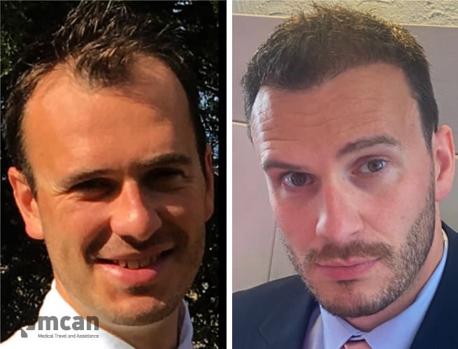 Best Hair Transplant Turkey - Istanbul 2023 | All Included Packages Best Hair Transplant Turkey - Istanbul 2023 | All Included Packages