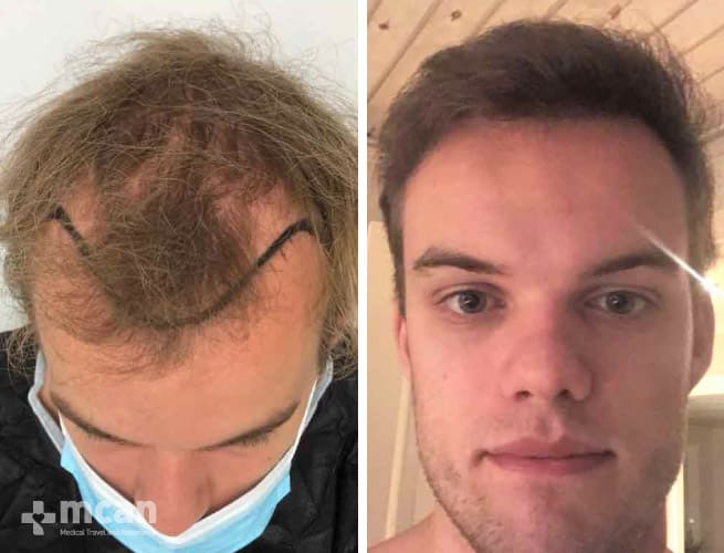 Astonishing hair transplant results before and after